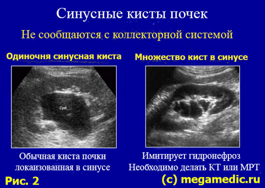 Синусовая киста почки