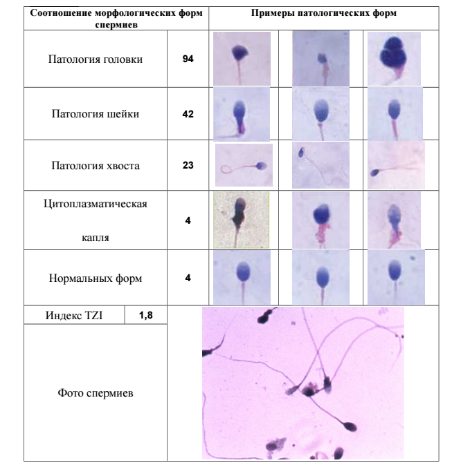 Схема лечения тератозооспермии форум