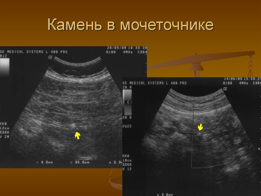 Камень нижней трети. Камень средней трети мочеточника. Конкремент мочеточника. Камень нижней трети мочеточника УЗИ. Камень в верхней трети мочеточника.