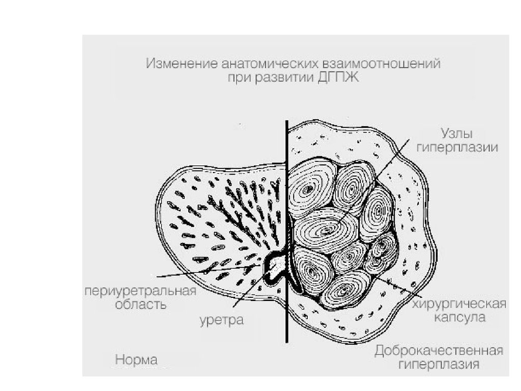 Предстательная железа это простата. Капсула предстательной железы. Хирургическая капсула предстательной. Хирургическая капсула предстательной железы на УЗИ. Простата зона периуретральных желез.