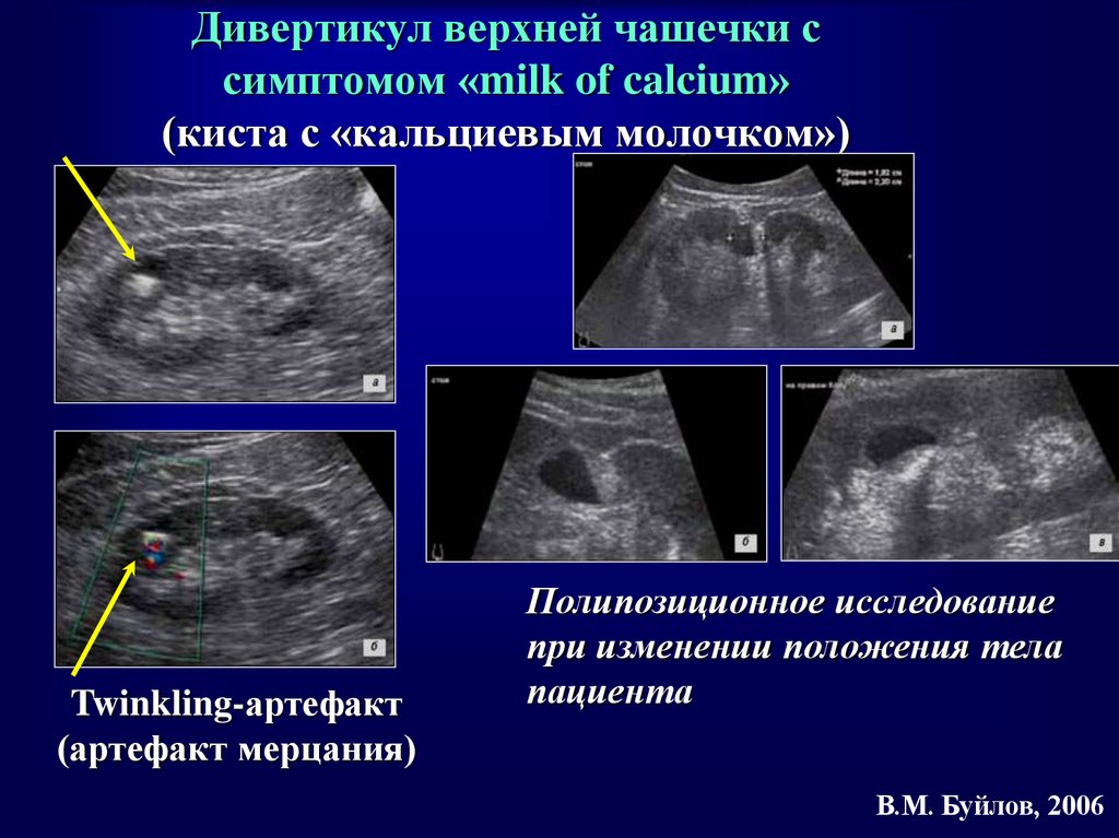 Мочевая киста