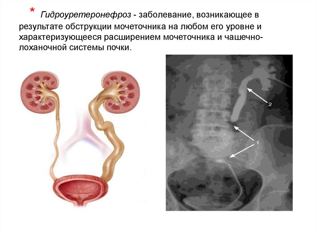 Нижняя треть мочеточника. Мочекаменная болезнь. Обструкция мочеточника. Гидронефроз гидроуретеронефроз. Синдром обтурации мочевыделительной системы. Обтурация мочеточника извне.