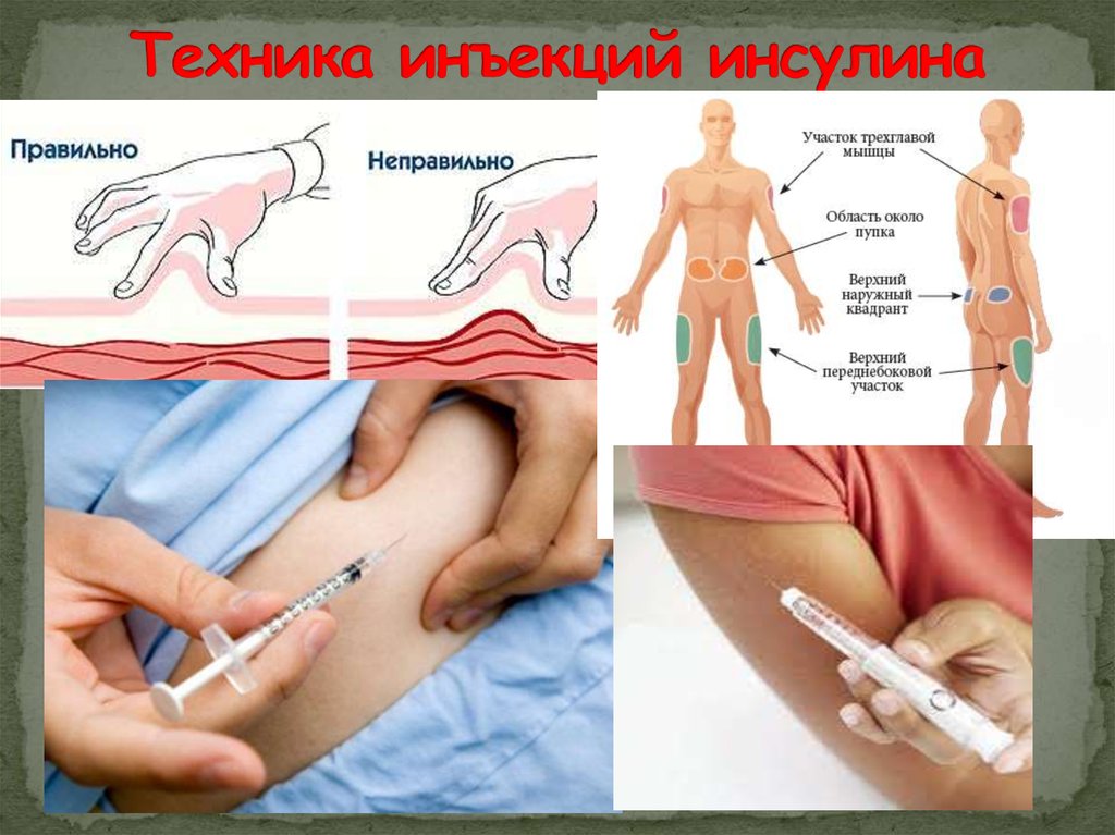 Фото подкожной инъекции в плечо с описанием техника постановки