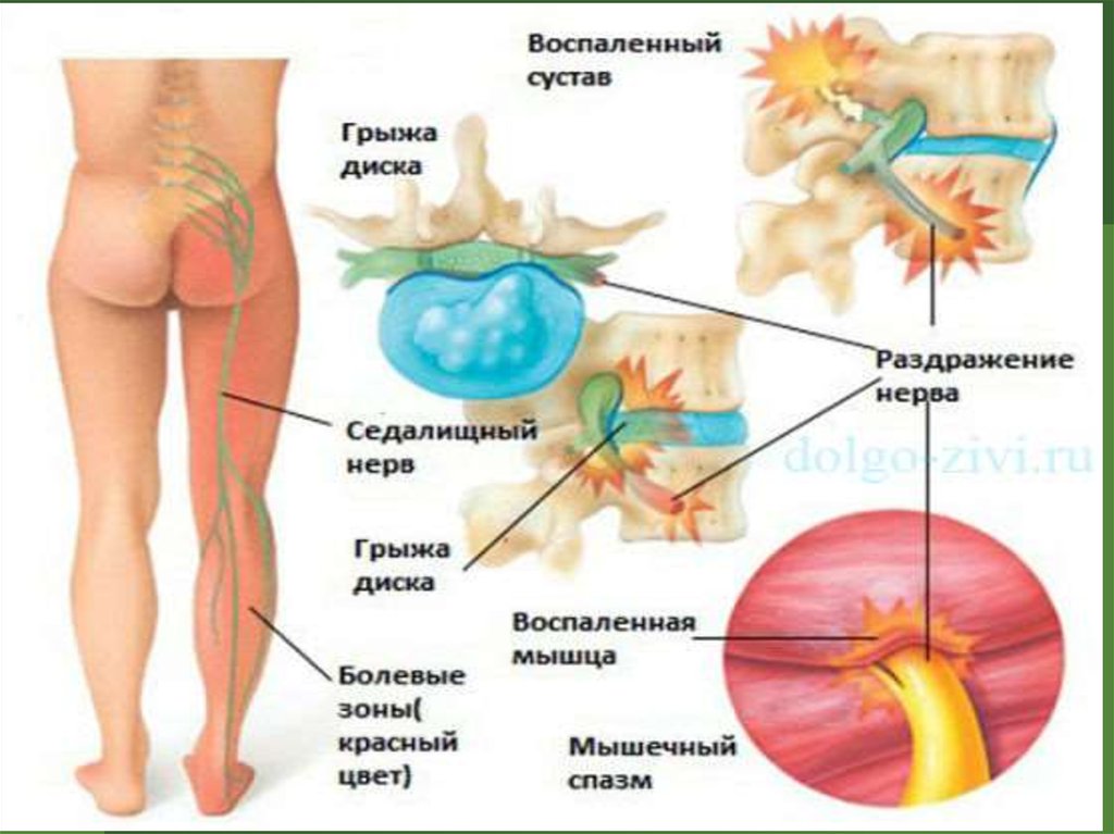 Защемило нерв в спине что делать