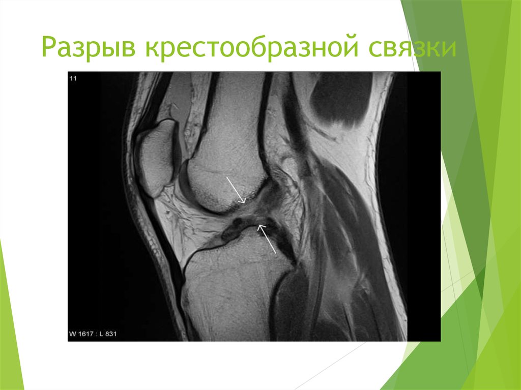 Повреждение передней крестообразной связки коленного сустава фото