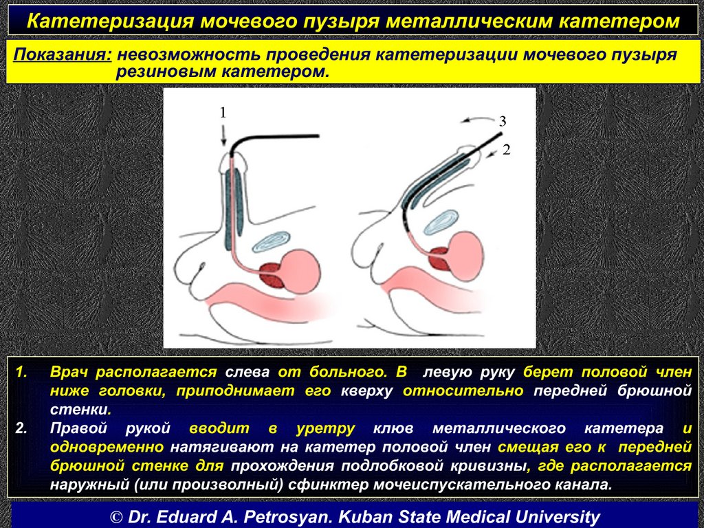 Как ставят катетер в мочевой пузырь мужчине при простатите с мешочком фото