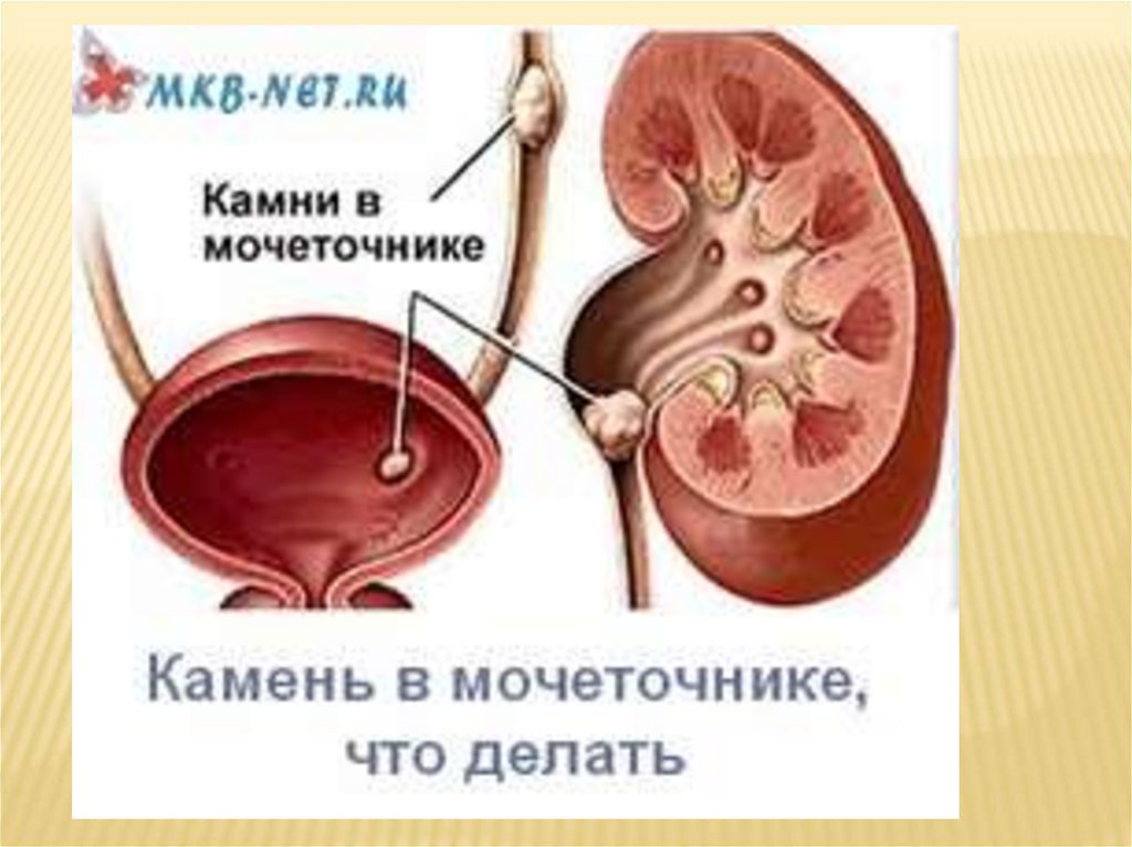 Что делают почки. Камень устья левого мочеточника 6 мм. Впадения мочеточника в мочевой пузырь. Мочекаменная болезнь мочевого пузыря. Камень в Устье правого мочеточника.