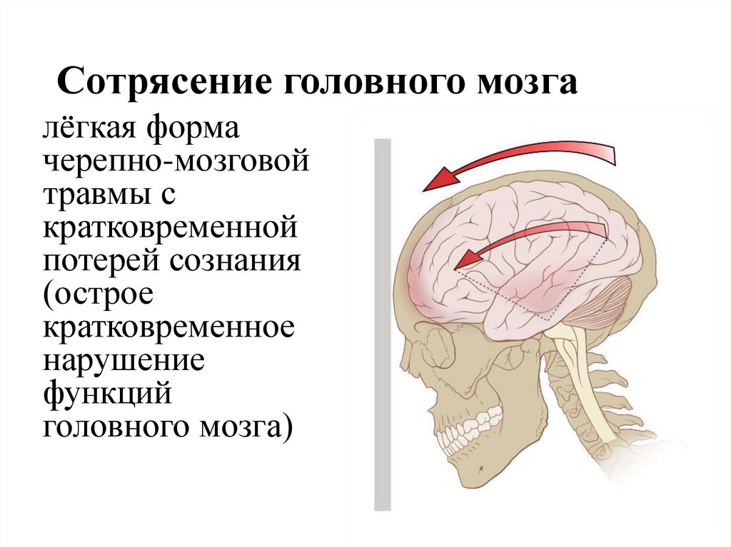 Сотрясение мозга признаки. Сотрясение головного мозга. Черепно-мозговая травма сотрясение головного мозга. Отрясениеголовного мозга.