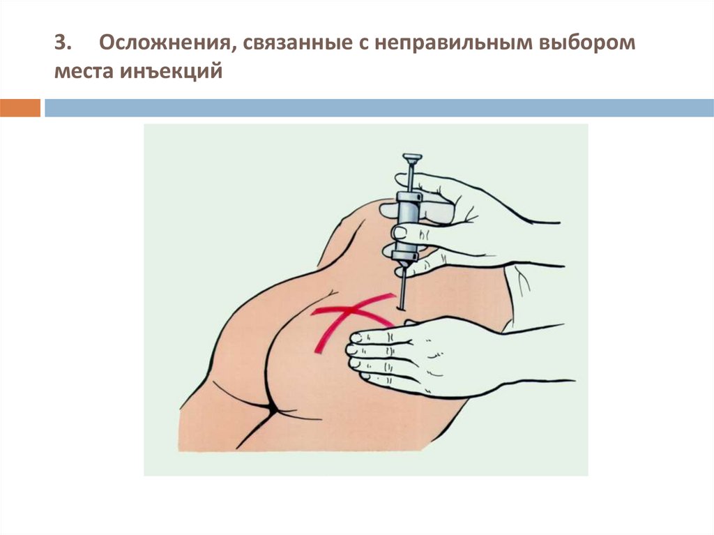 Осложнения подкожной инъекции. Инфильтрат внутримышечной инъекции. Осложнения инъекций. Осложнения внутримышечных инъекций. Внутримышечное и внутривенное Введение.