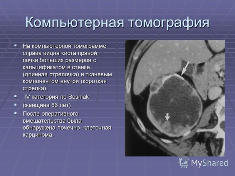 Киста правой почки. Плотность кисты почки на кт.