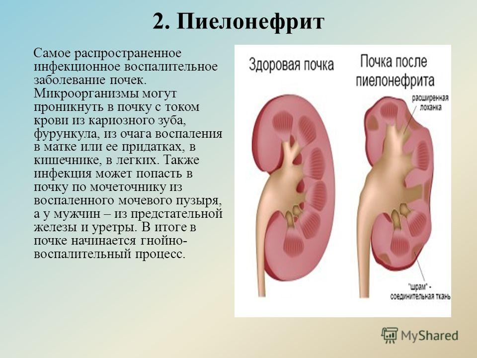 Хронический пиелонефрит презентация