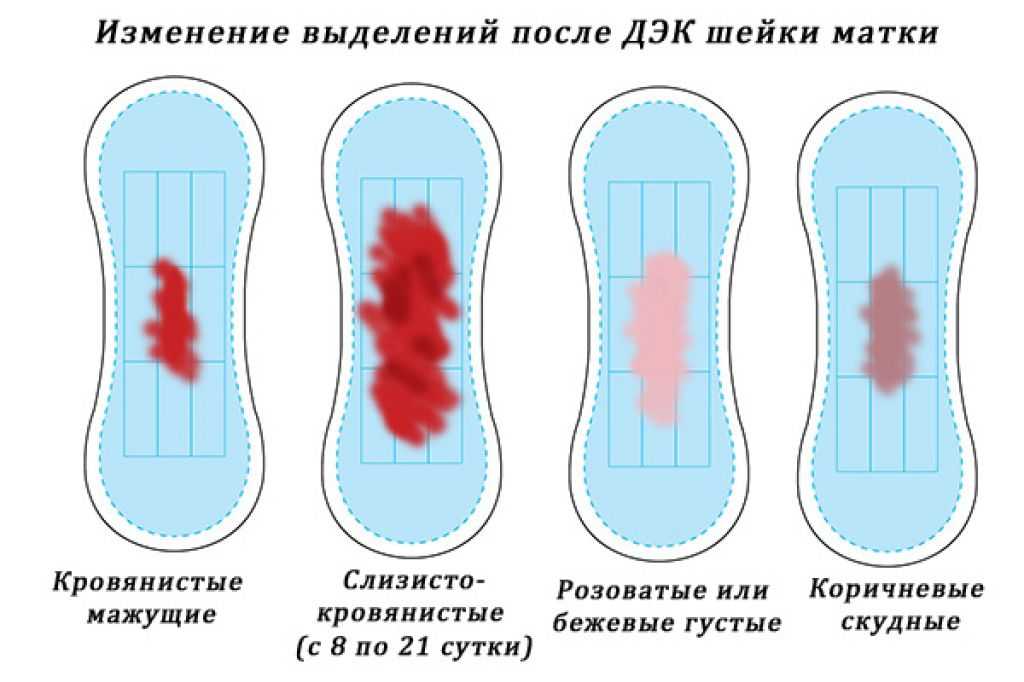 Виды месячных. Шейка матки после прижигания. Выделения после прижигания эрозии. Эрозия шейки после прижигания. Нормальный цвет менструальной крови.