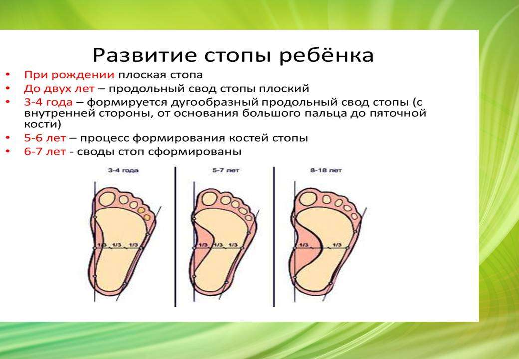 Плоскостопие 2 степени