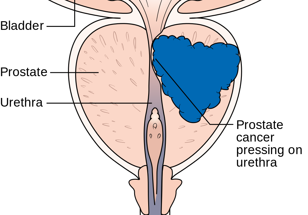 Предстательная железа это простата. Семенной бугорок предстательной железы. Семенной холмик простаты. Семенной бугорок предстательной железы на УЗИ. Карцинома предстательной железы.