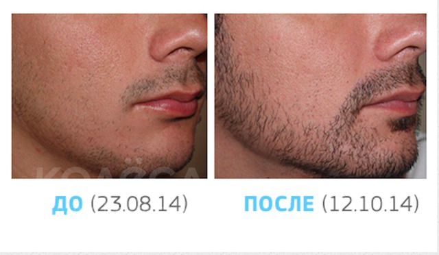 Миноксидил для бороды до и после с фото