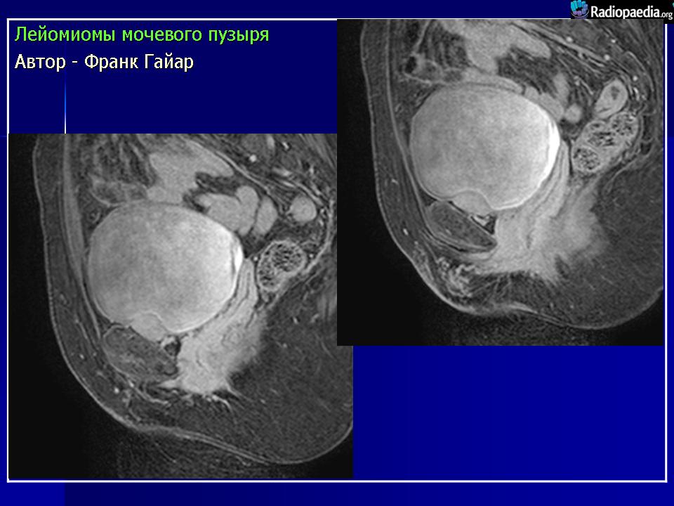 Лейомиома мочевого пузыря кт. Лейомиома мочевого пузыря мрт. Полип мочевого пузыря на кт.