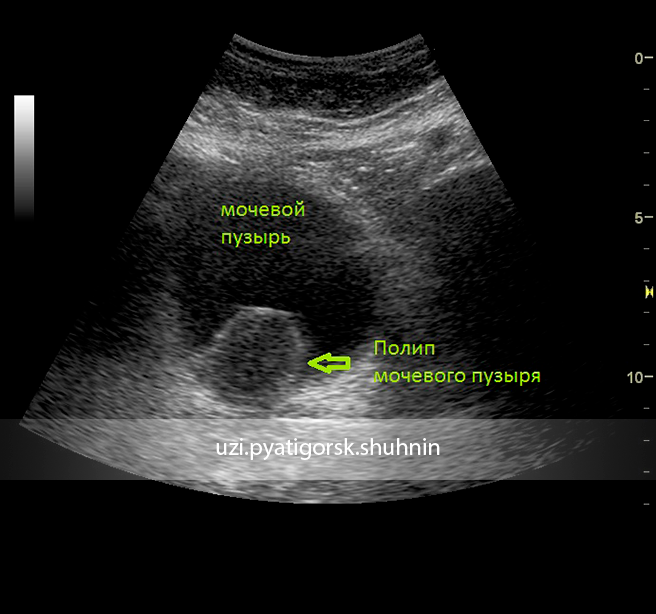 Узи пузыря. Полип мочевого пузыря по УЗИ. Полипоз мочевого пузыря на УЗИ. УЗИ мочевого пузыря видео.
