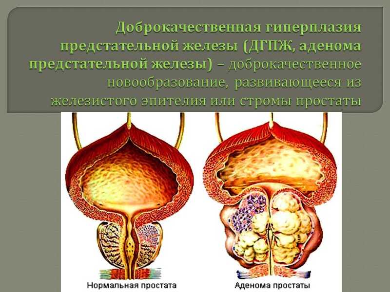 Как лечить гиперплазию предстательной железы у мужчин. Железисто-стромальная гиперплазия предстательной железы. Гиперплазия предстательной железы патанатомия. Доброкачественная гиперплазия предстательной железы (ДГПЖ). ДГПЖ предстательной железы что это такое.