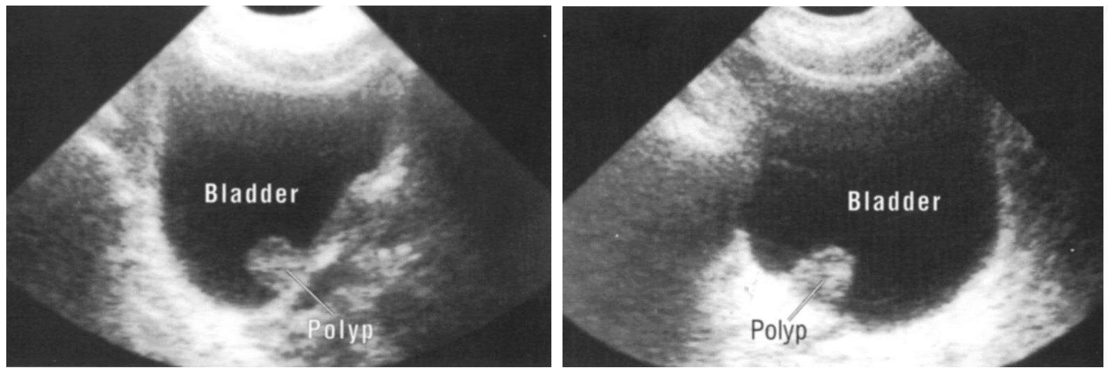 Операция на мочевом пузыре у мужчин. Полип мочевого пузыря на УЗИ. Как выглядит полип мочевого пузыря на УЗИ. Полип устья мочеточника.