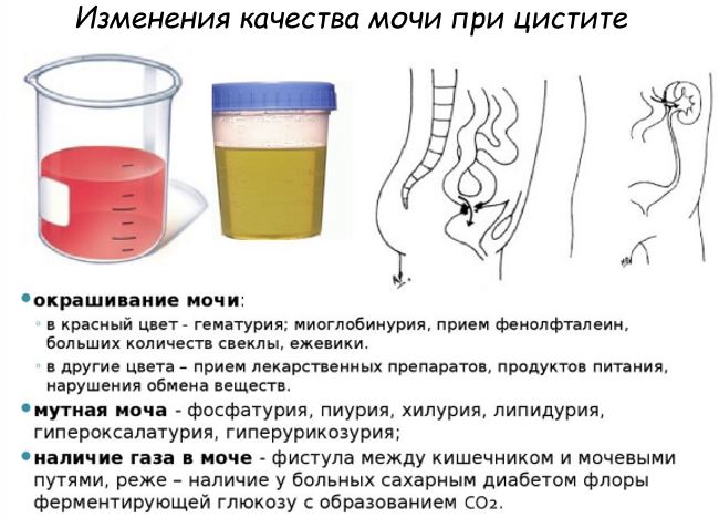 При каком заболевании моча. Моча при цистите. Моча с запахом. Моча при цистите у женщин. Цвет мочи при цистите.