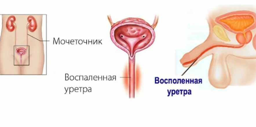 Симптомы уретрита. Острый неспецифический уретрит. Воспаление мочеиспускательного канала у женщин симптомы. Негонококковый уретрит.