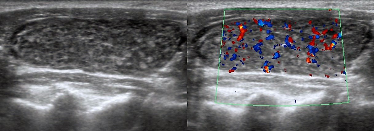 Диффузный токсический зоб узи картина