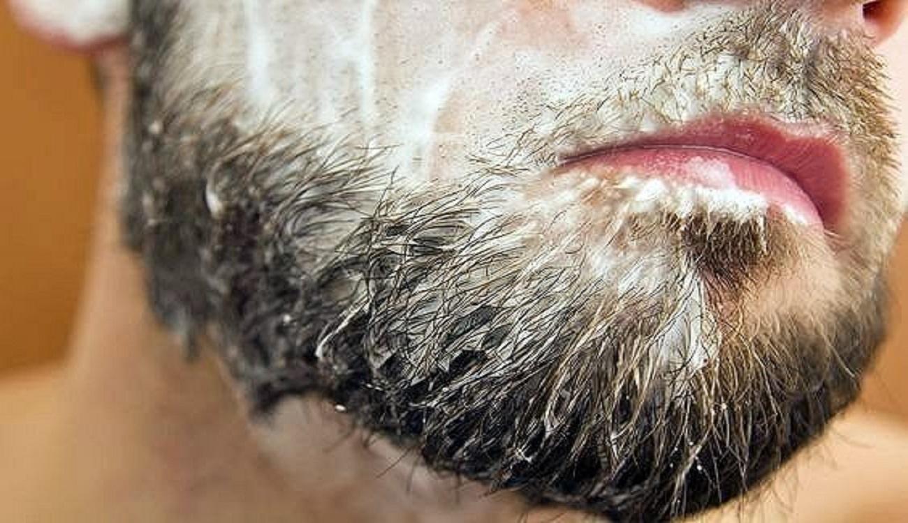 После бритья бороды. Себорея волосяного Покрова. Себорейный дерматит на бороде.