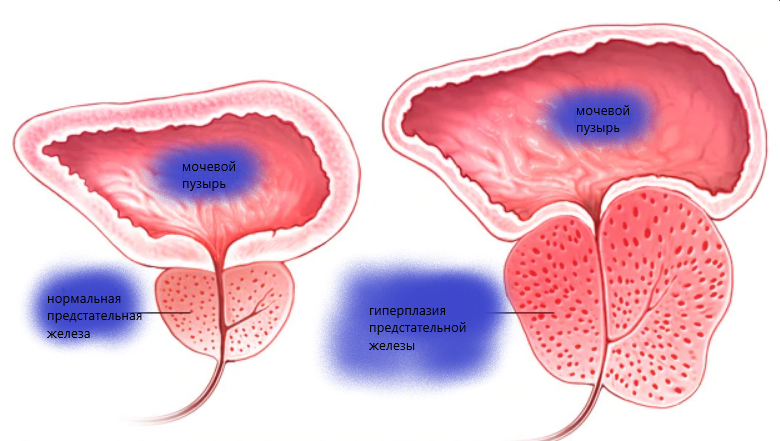 Что значит гиперплазия предстательной железы. Аденома (гиперплазия) предстательной железы патогенез. Секреторная функция предстательной железы. Аденома предстательной железы этиология. Доброкачественная гиперплазия предстательной железы (ДГПЖ).