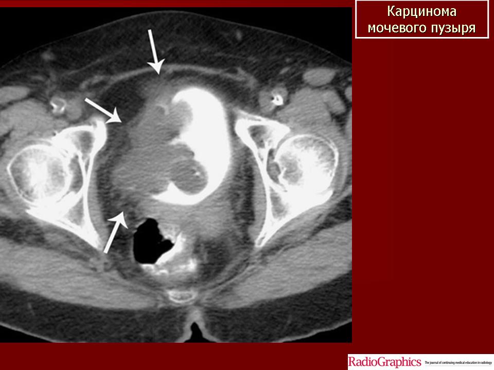 Мрт мочевого пузыря. Кт опухоль мочевого пузыря снимок. Опухоль мочевого пузыря кт мрт. Конкременты мочевого пузыря кт. Карцинома мочевого пузыря мрт.