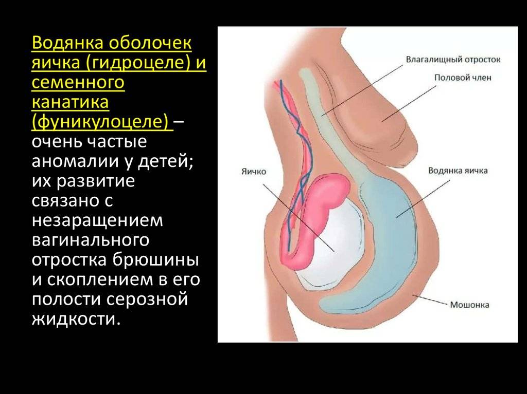 Презентация водянка яичка