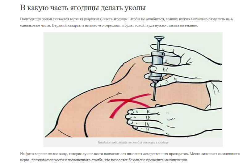 Как часто нужно колоть. Схема введения укола в ягодицы. Схема внутримышечного укола. Место постановки укола в ягодицу. Схема уколов внутримышечно в ягодицу.