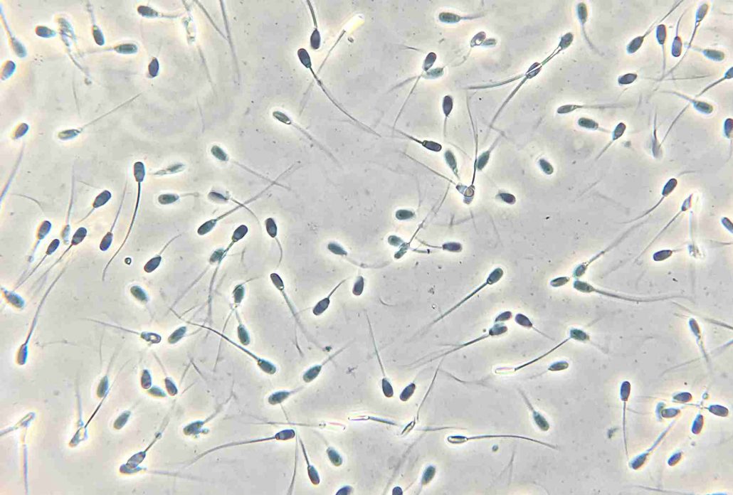 Клетка семени. Астенотератозооспермия под микроскопом. Некроспермия. Сперматофорное осеменение. Астенозооспермия фото.
