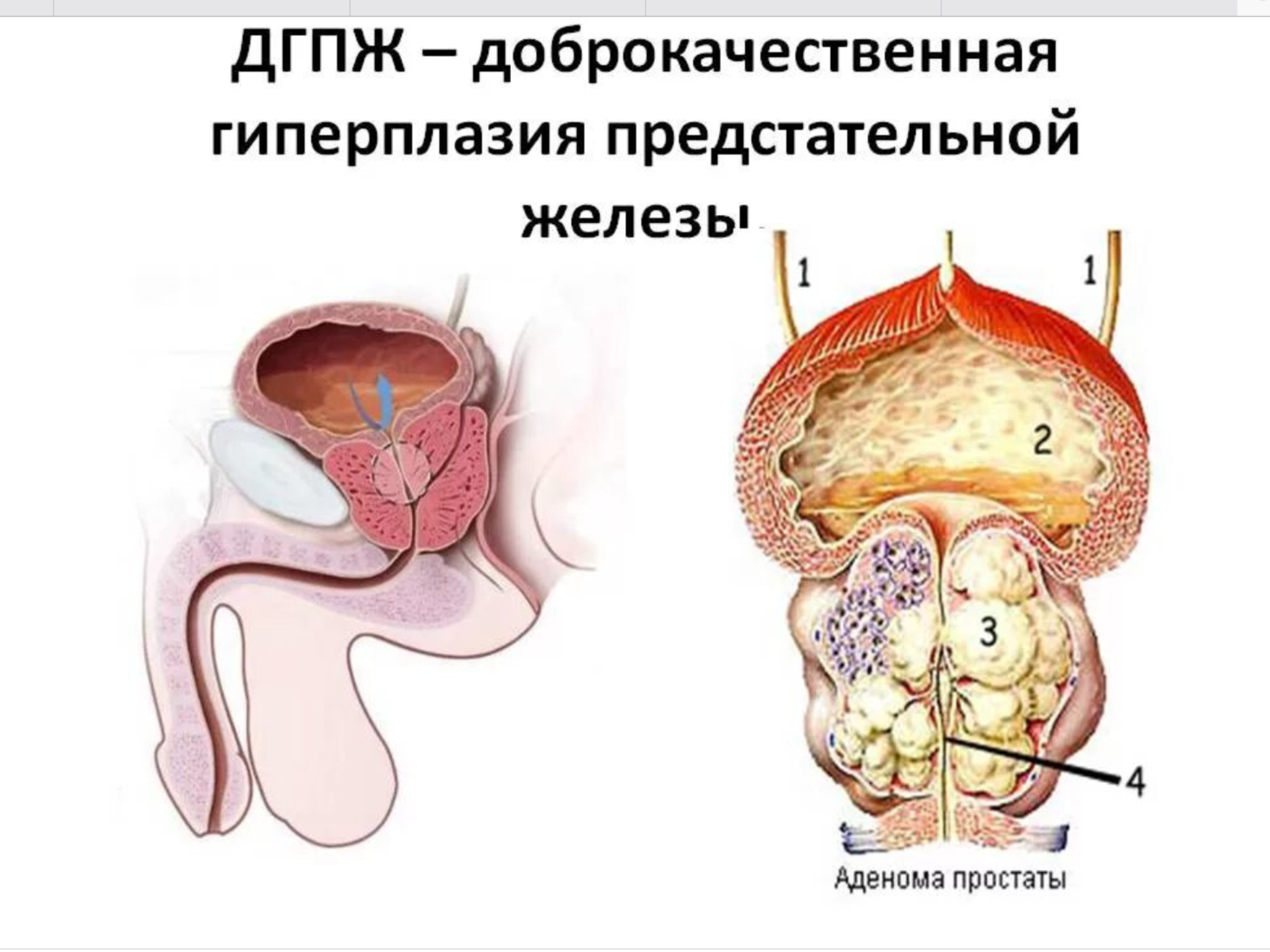 Стадии дгпж. Аденома предстательной железы и ДГПЖ. Узловая гиперплазия предстательной железы этиология. ДГПЖ предстательной железы что это такое.